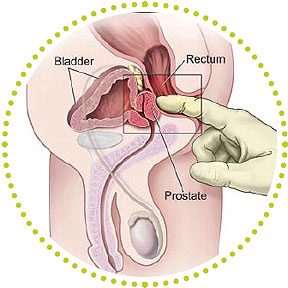 Prostate Cancer Prognosis